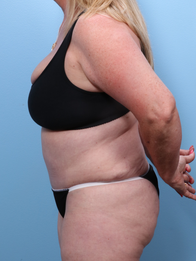 Tummy Tuck Patient Photo - Case 1757 - after view-2