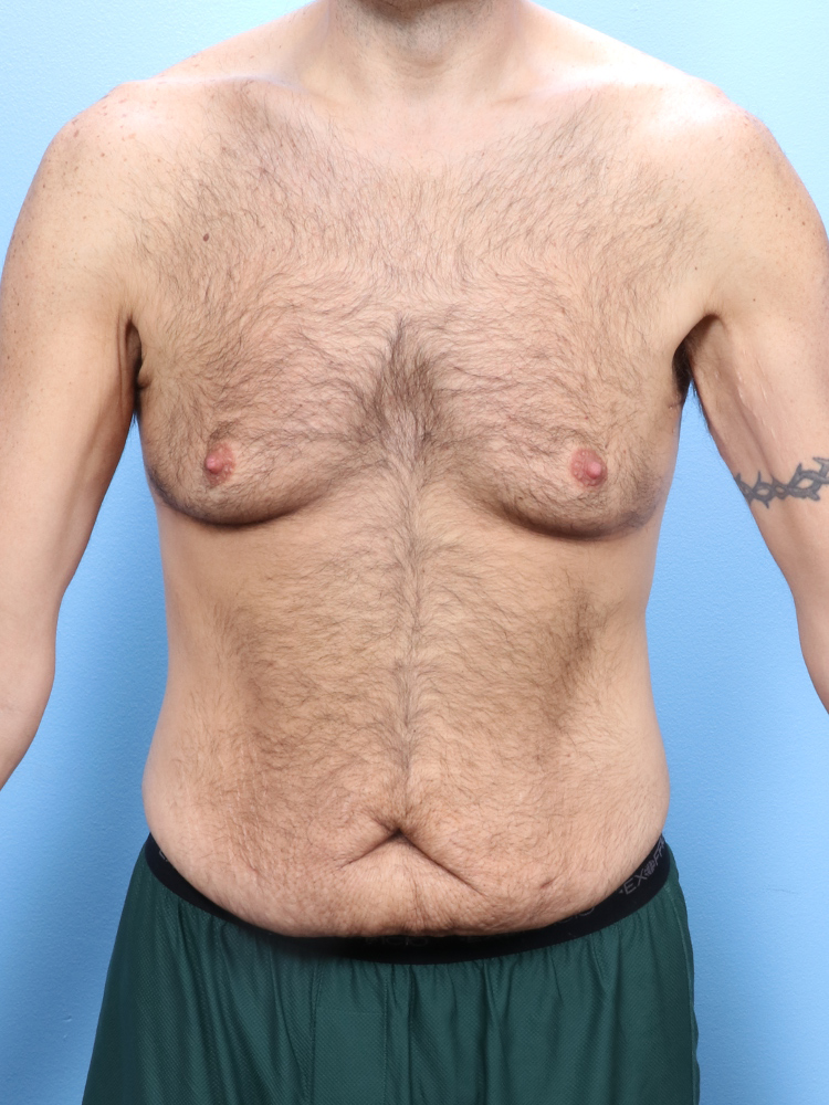 Male Tummy Tuck - Case 1760 - Before