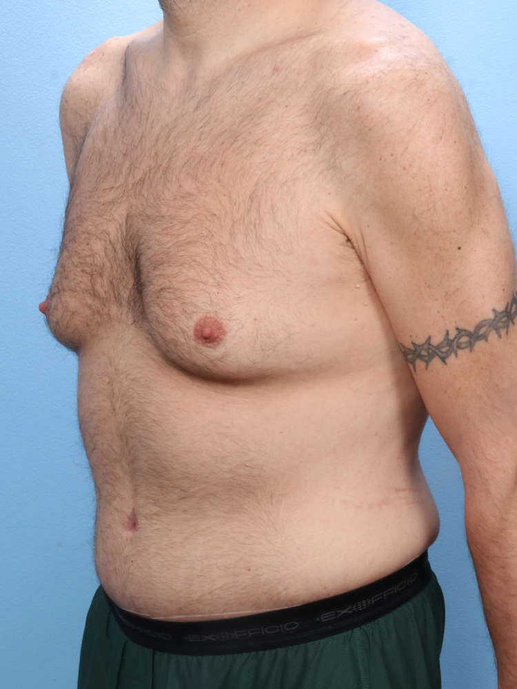 Male Tummy Tuck Patient Photo - Case 1760 - after view-1
