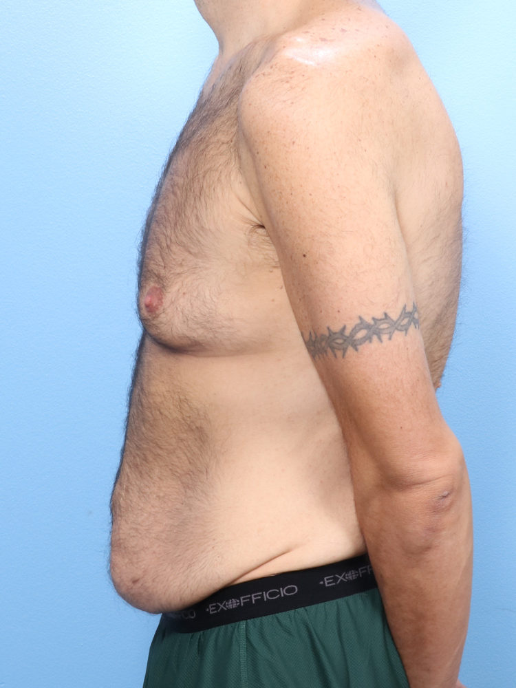 Male Tummy Tuck Patient Photo - Case 1760 - before view-2