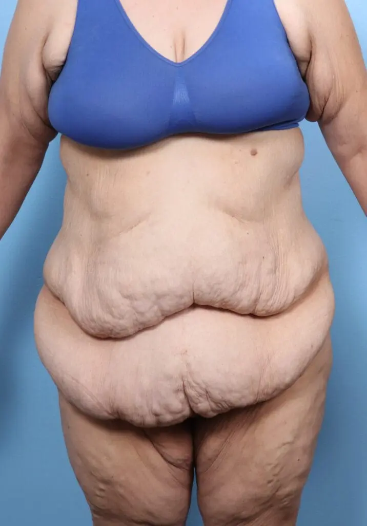 Tummy Tuck - Case 1768 - Before