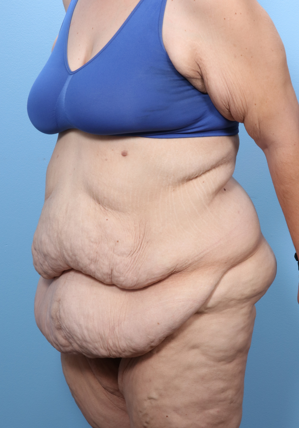 Tummy Tuck Patient Photo - Case 1768 - before view-1