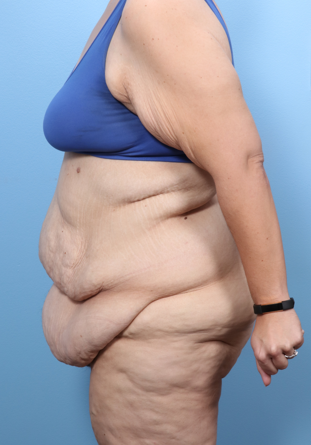 Tummy Tuck Patient Photo - Case 1768 - before view-2