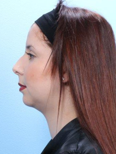 Before Chin Implants