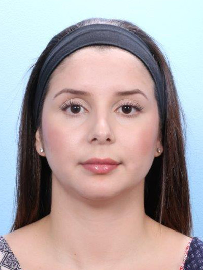 Chin Implant Patient Photo - Case 1769 - after view-1
