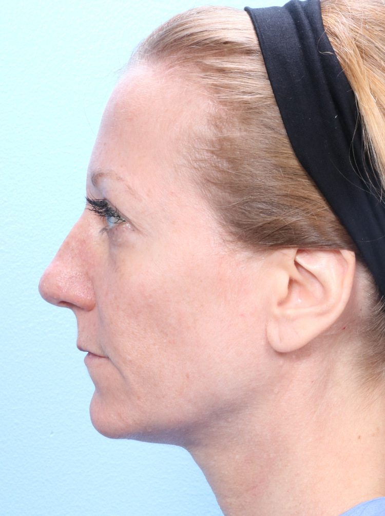 Rhinoplasty - Case 1773 - Before
