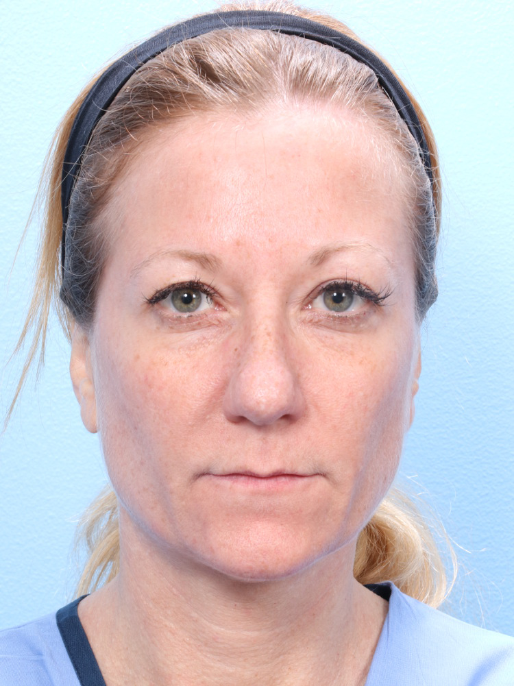 Rhinoplasty Patient Photo - Case 1773 - before view-1