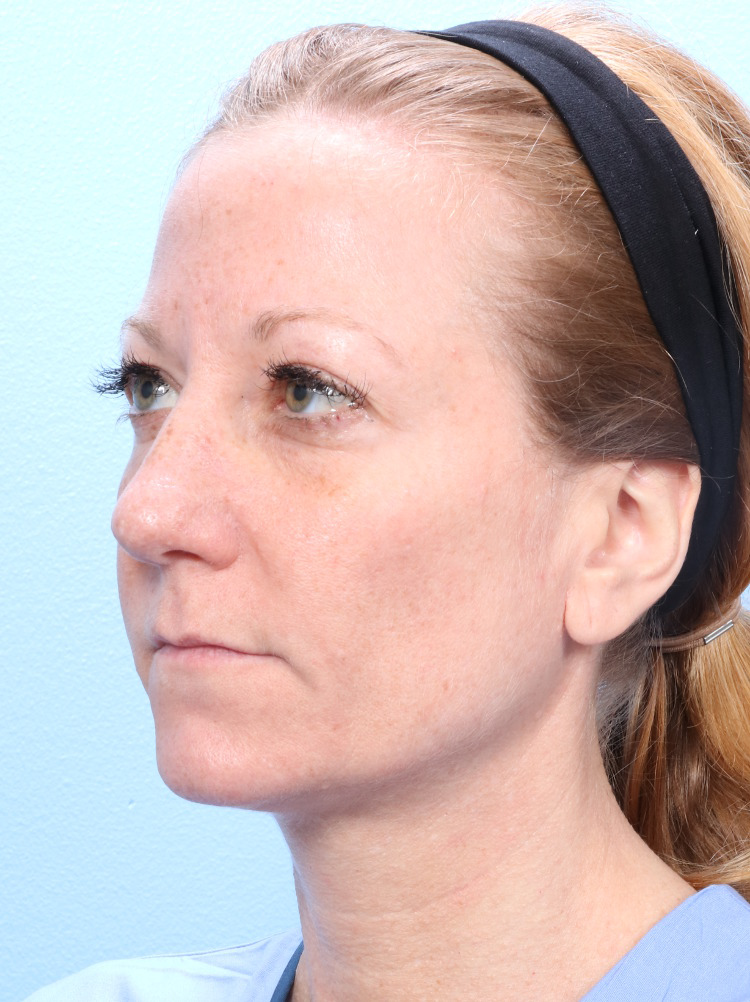 Rhinoplasty Patient Photo - Case 1773 - before view-2