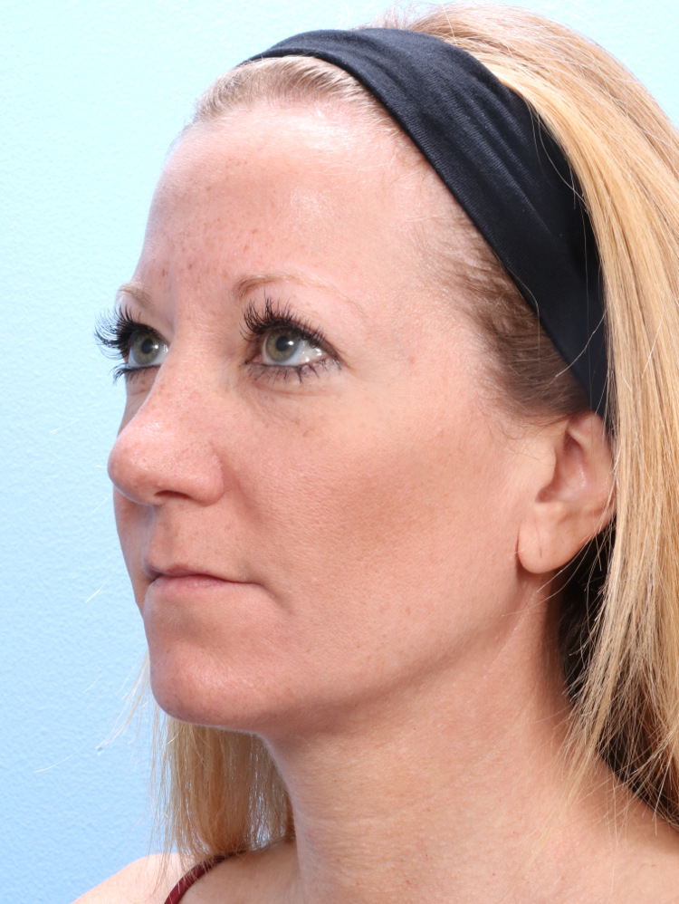 Rhinoplasty Patient Photo - Case 1773 - after view-2