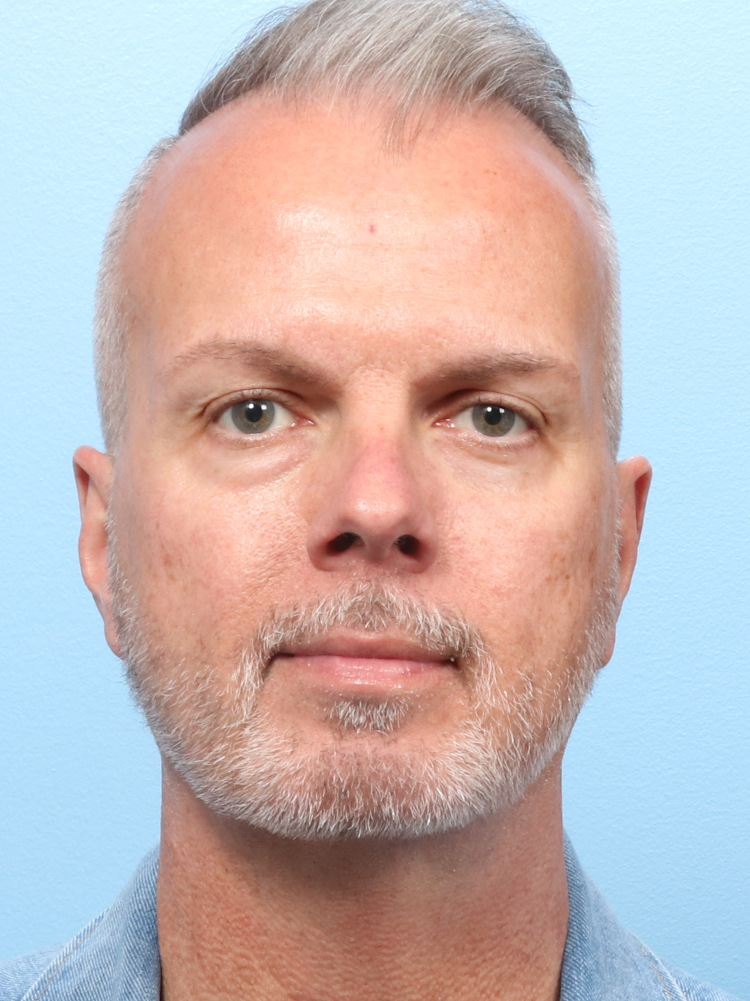 Male Facial Surgery - Case 1779 - Before