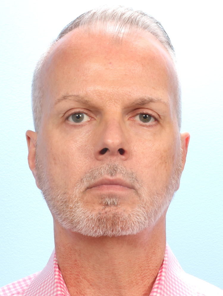 Male Facial Surgery - Case 1779 - After