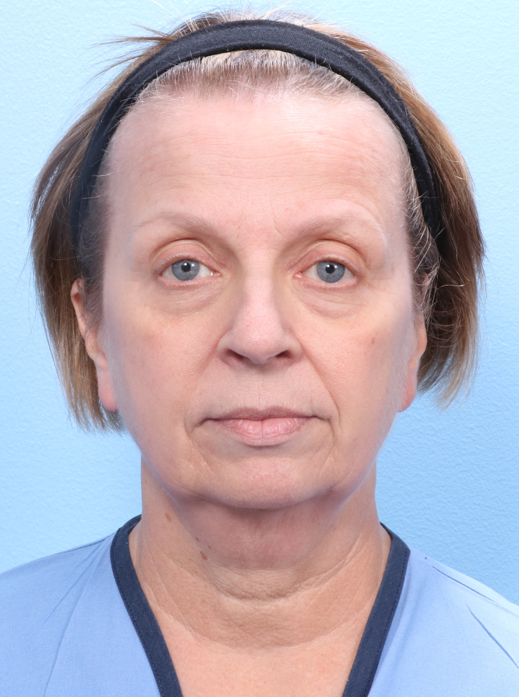 Facelift / Neck Lift - Case 1787 - Before