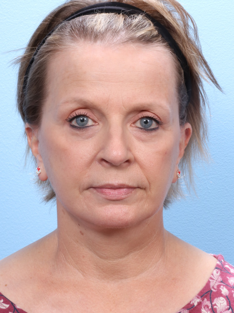Facelift / Neck Lift - Case 1787 - After