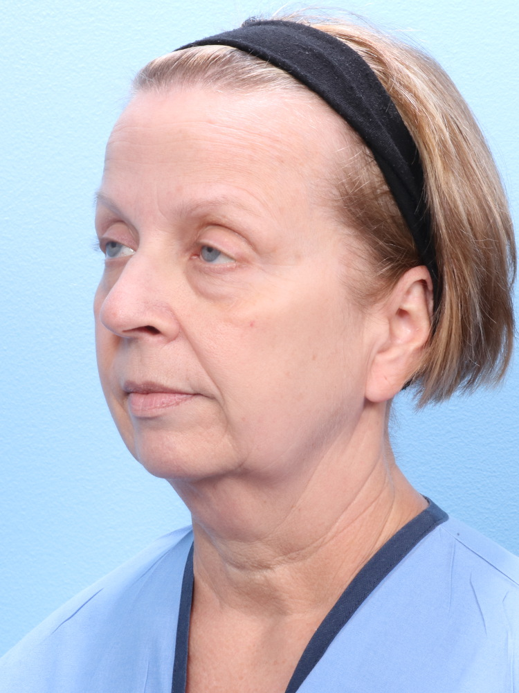 Eyelid Surgery Patient Photo - Case 1787 - before view-1