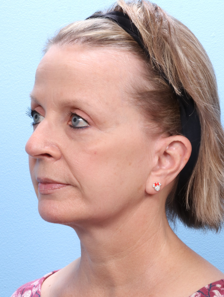 Facelift / Neck Lift Patient Photo - Case 1787 - after view-1