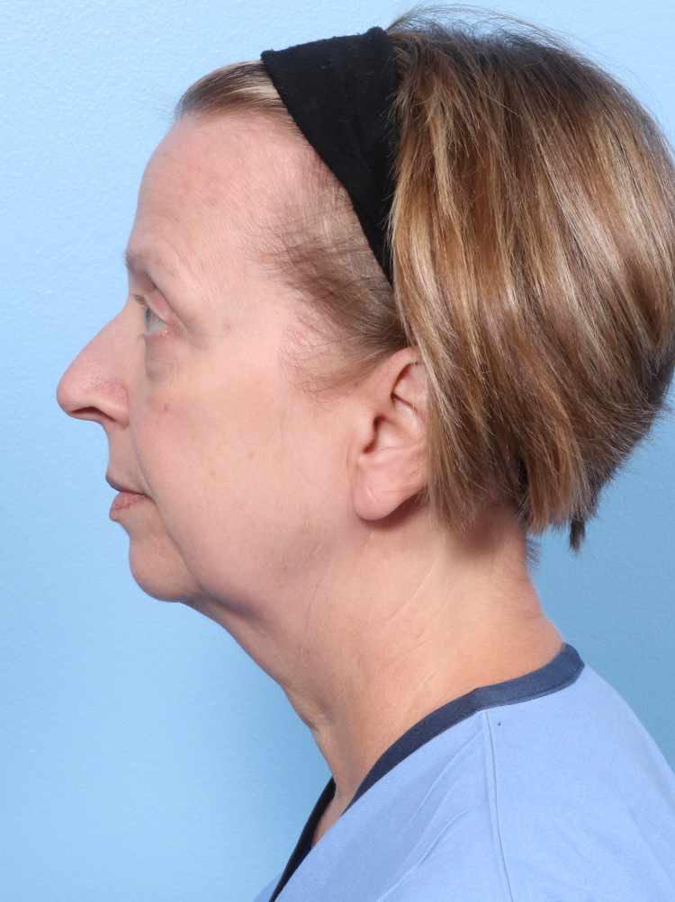 Facelift / Neck Lift Patient Photo - Case 1787 - before view-2