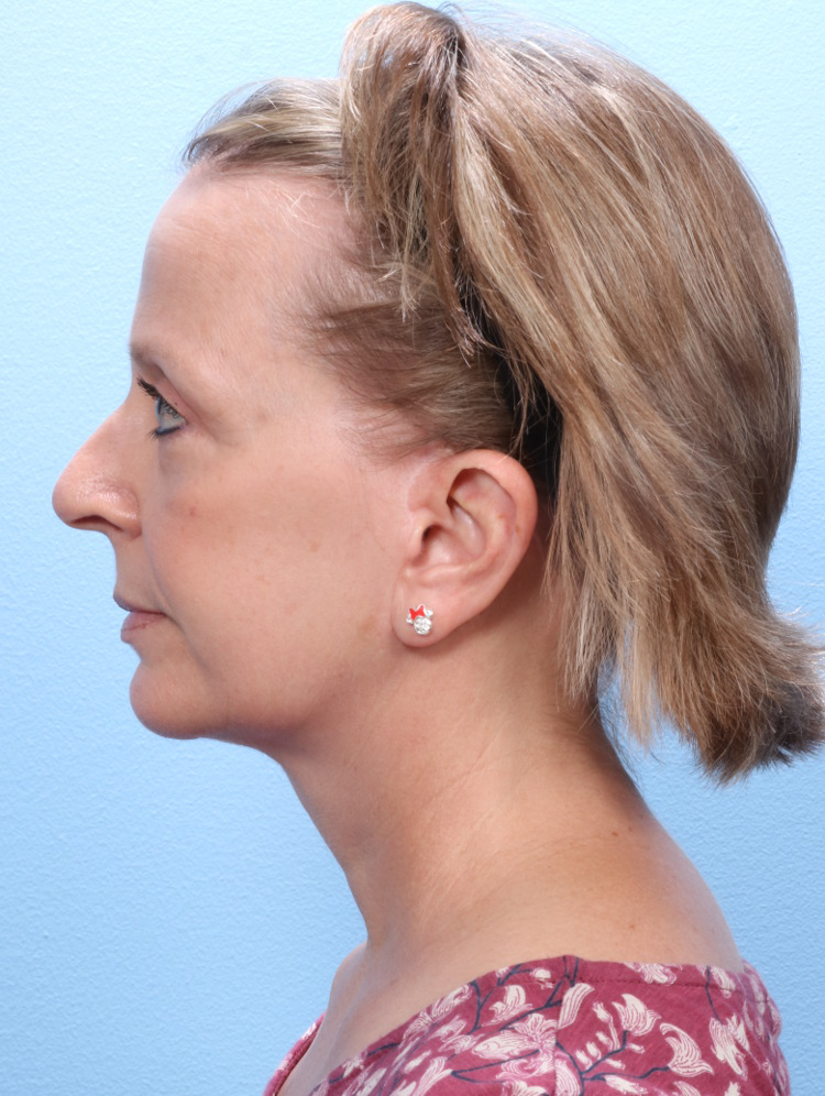 Eyelid Surgery Patient Photo - Case 1787 - after view-2