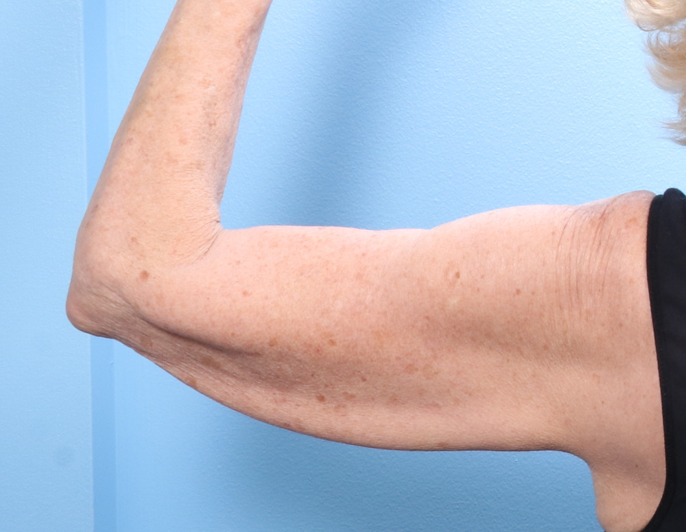 Arm Lift Patient Photo - Case 1792 - before view-1