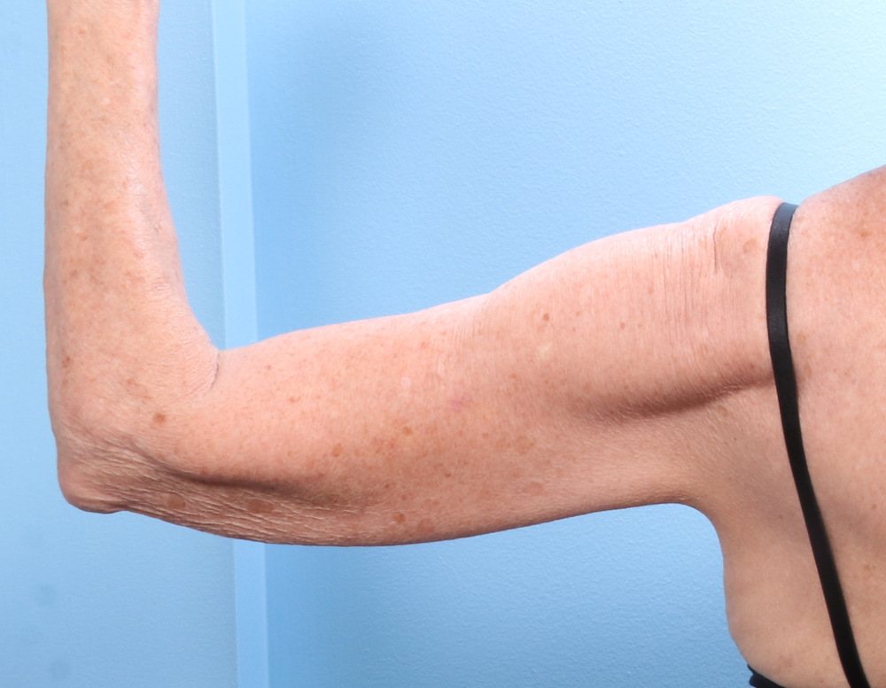Arm Lift Patient Photo - Case 1792 - after view-1