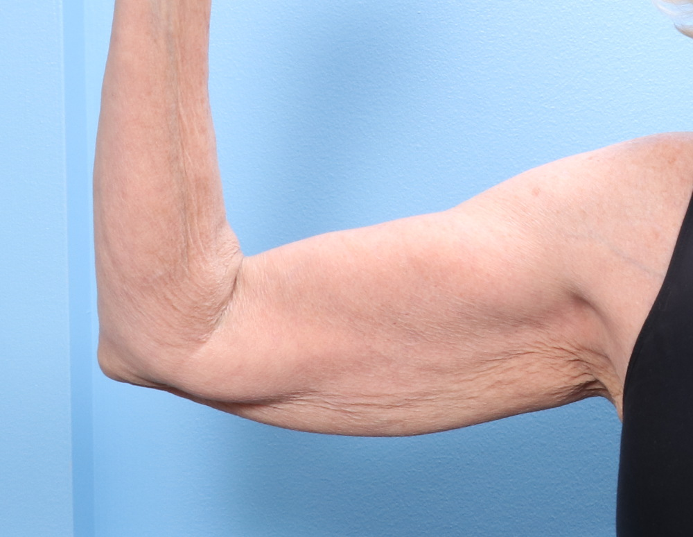 Arm Lift - Case 1792 - Before