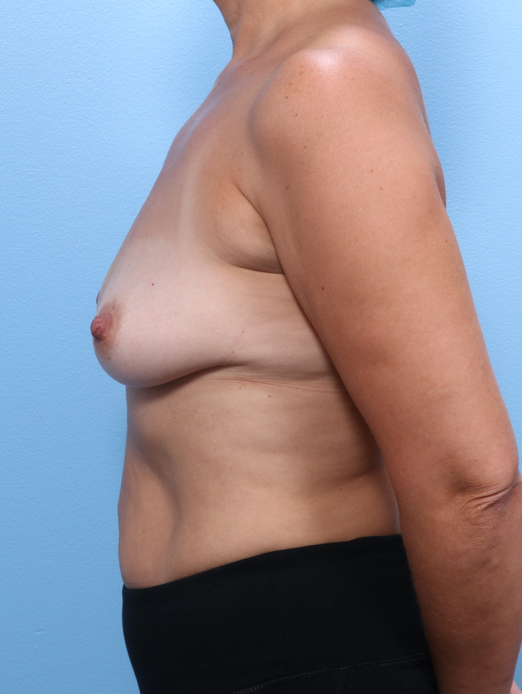 Breast Lift/Reduction with Implants Patient Photo - Case 1796 - before view-2