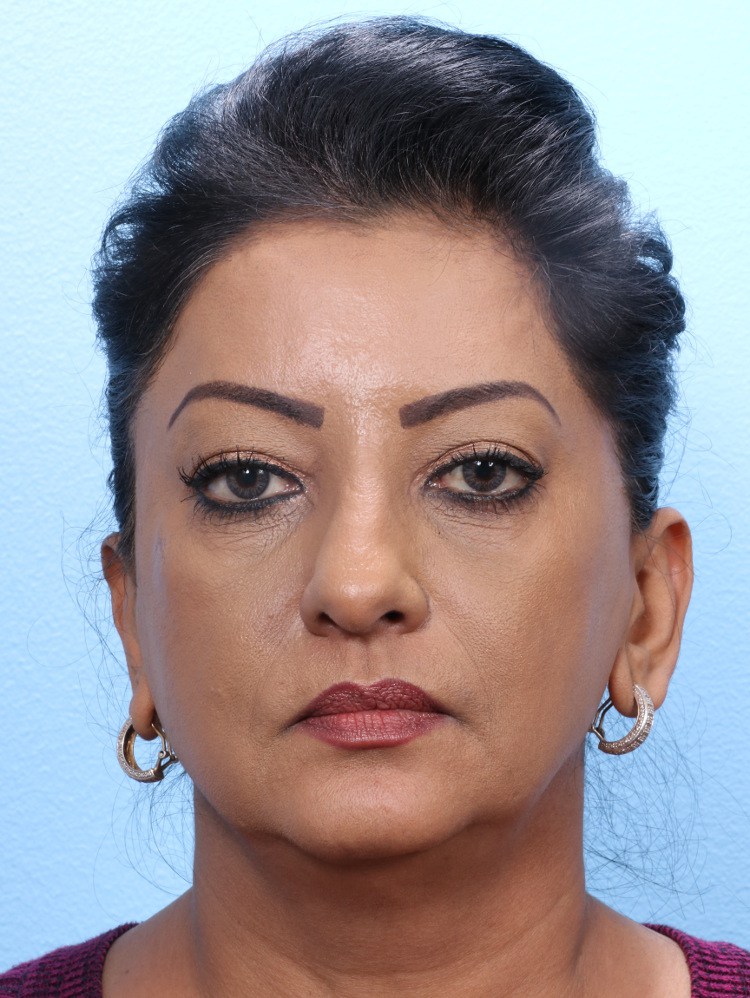 Eyelid Surgery - Case 1802 - Before