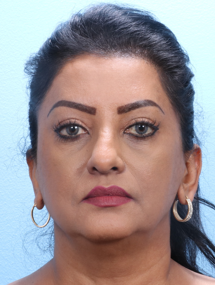 Eyelid Surgery - Case 1802 - After