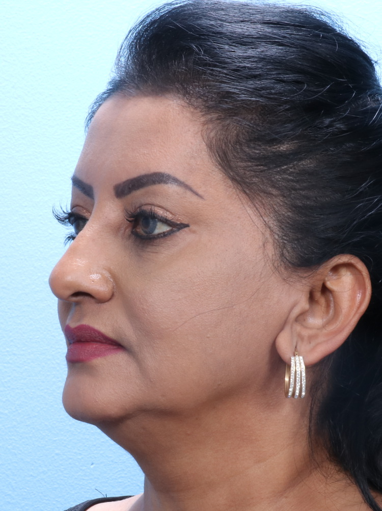 Eyelid Surgery Patient Photo - Case 1802 - after view-1