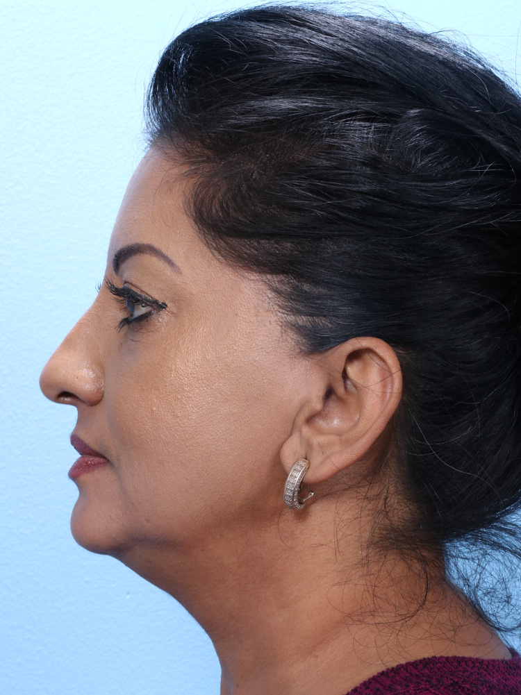Eyelid Surgery Patient Photo - Case 1802 - before view-2