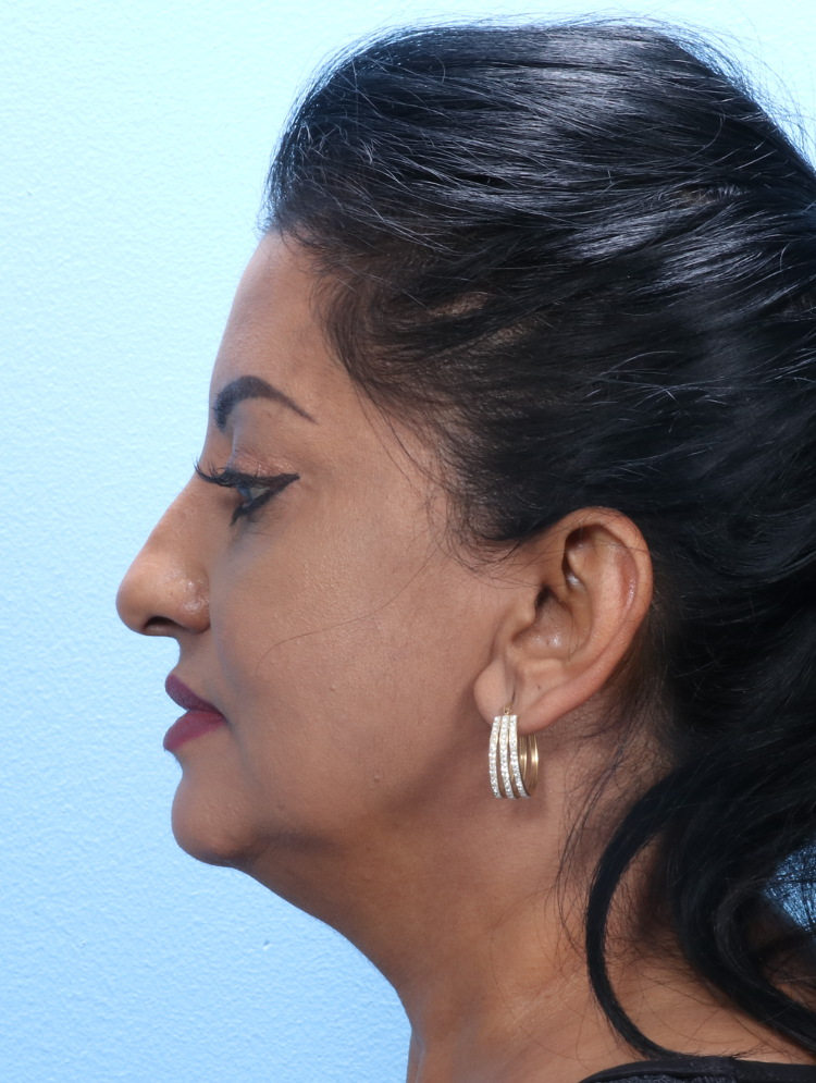 Eyelid Surgery Patient Photo - Case 1802 - after view-2