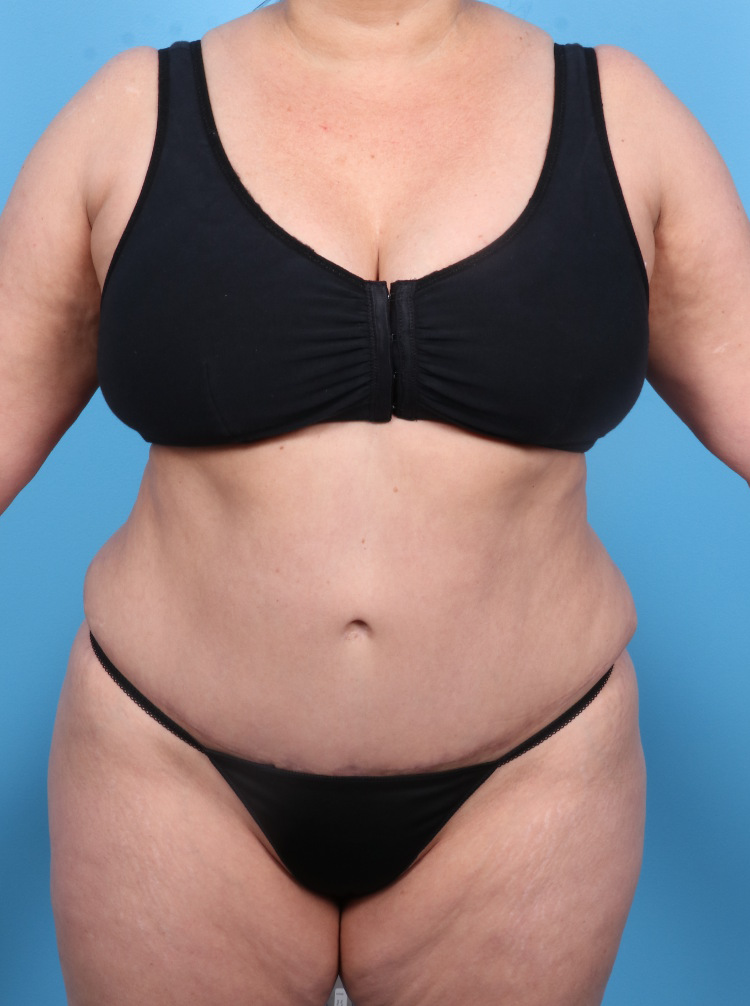 Tummy Tuck - Case 1804 - After