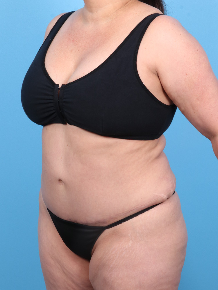 Tummy Tuck Patient Photo - Case 1804 - after view-1