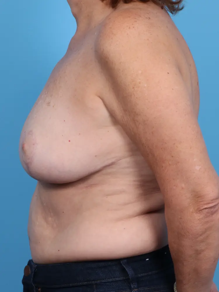 Breast Lift/Reduction w/o Implants Patient Photo - Case 1823 - after view-2