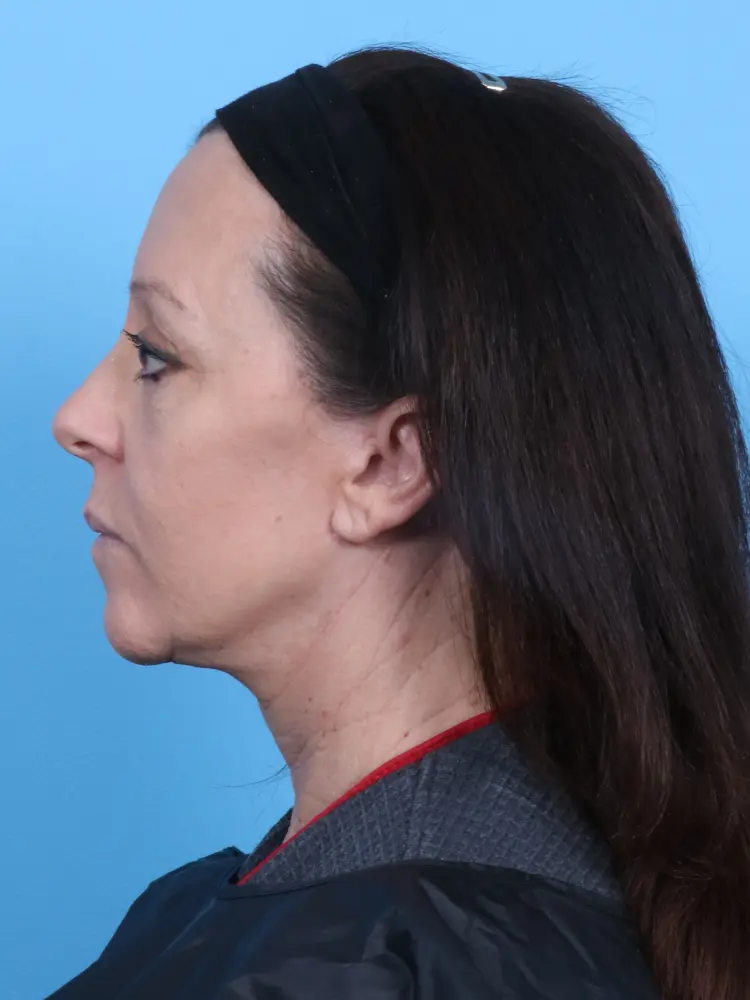 Facelift / Neck Lift Patient Photo - Case 1824 - after view-2