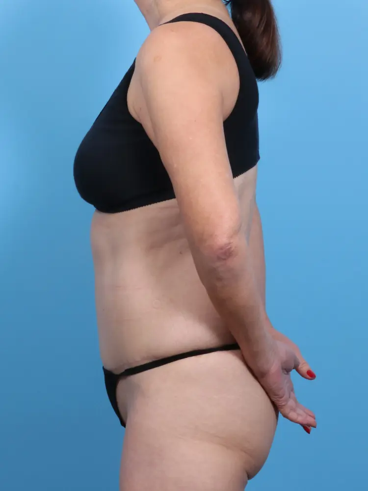 Tummy Tuck Patient Photo - Case 1815 - after view-2