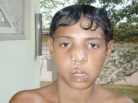 Volunteer Reconstructive Surgery - Case 296 - After