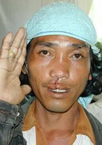 Volunteer Reconstructive Surgery - Case 327 - After