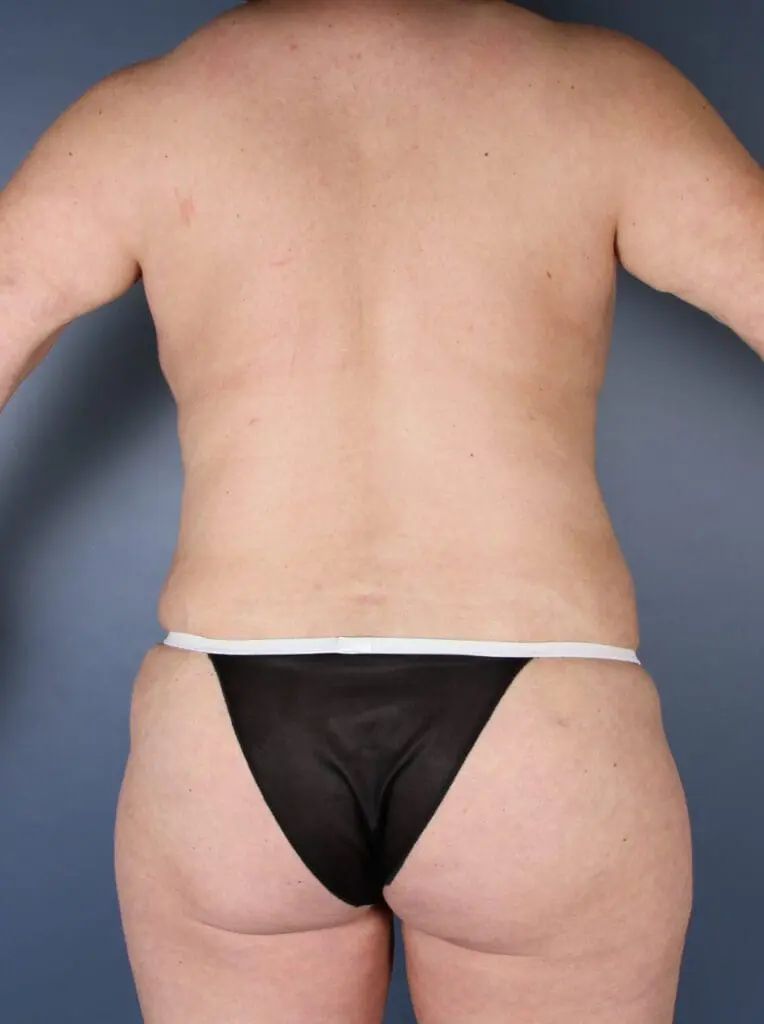 Liposuction - Case 1475 - After