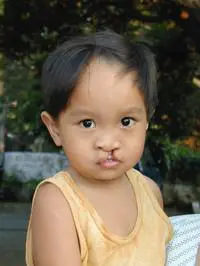 Volunteer Reconstructive Surgery - Case 290 - Before