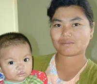 Volunteer Reconstructive Surgery - Case 324 - After