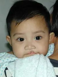 Volunteer Reconstructive Surgery - Case 291 - Before