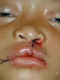 Volunteer Reconstructive Surgery - Case 321 - After