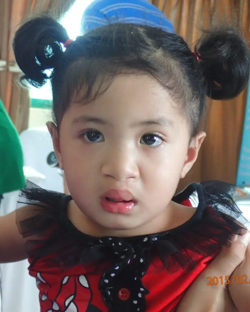 Volunteer Reconstructive Surgery - Case 1486 - After