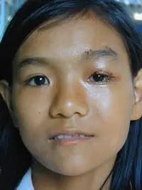 Volunteer Reconstructive Surgery - Case 276 - After