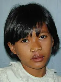 Volunteer Reconstructive Surgery - Case 284 - After