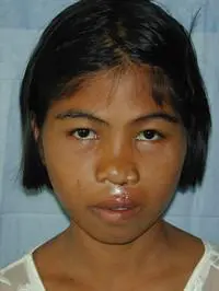 Volunteer Reconstructive Surgery - Case 283 - After