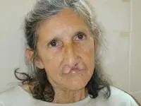 Volunteer Reconstructive Surgery - Case 298 - Before