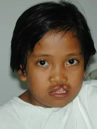 Volunteer Reconstructive Surgery - Case 318 - Before