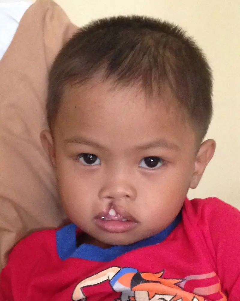 Volunteer Reconstructive Surgery - Case 1488 - Before