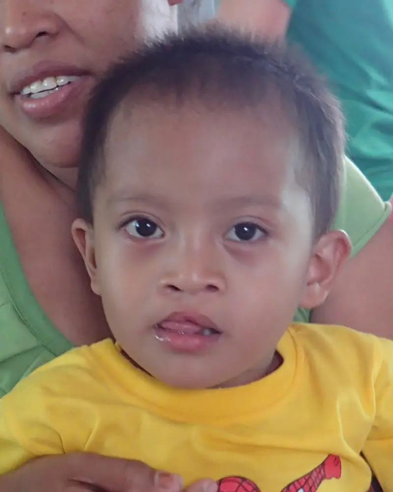 Volunteer Reconstructive Surgery - Case 1488 - After